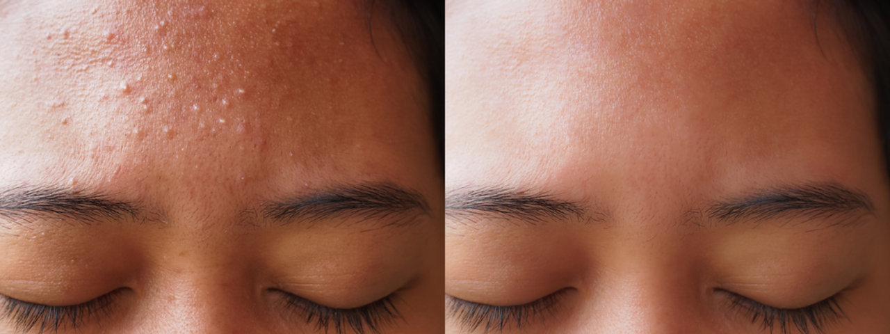 Acne Facial Treatments in Malvern -Our innovative three-step acne treatment protocol combines deep cleansing, a purifying peel, and advanced rehydration techniques to deliver optimal results.